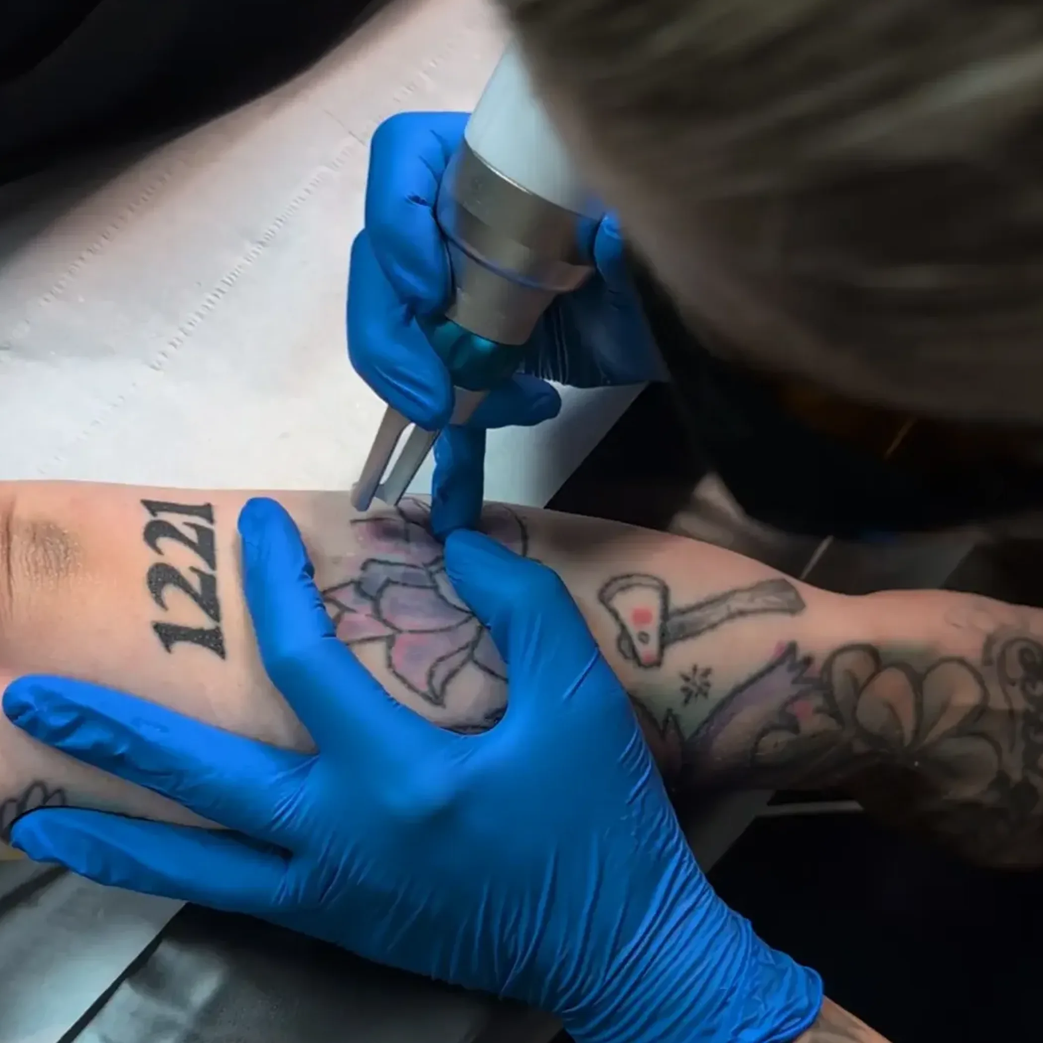 close up laser tattoo removal skin treatment